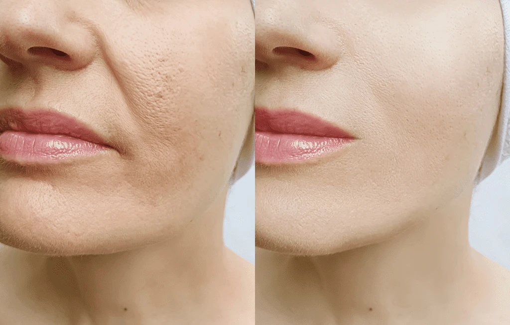 Resultados de los hilos tensores valencia