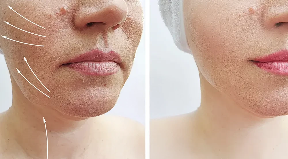 Resultados de los hilos tensores