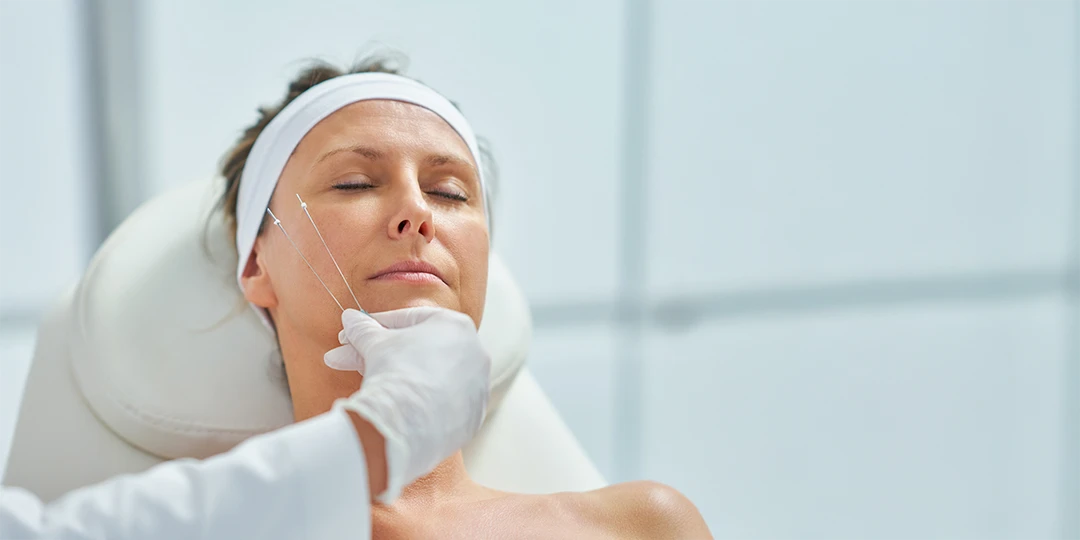 Tratamiento de hilos tensores Se realiza con cirugía